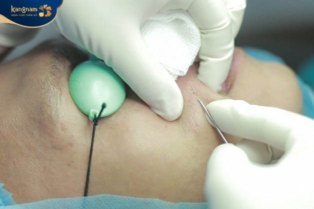 phương pháp bóc tách sẹo