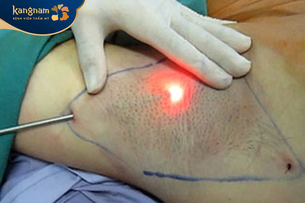 Hút tuyến mồ hôi tại Kangnam an toàn, hiệu quả