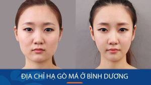 Hạ gò má kangnam Bình Dương