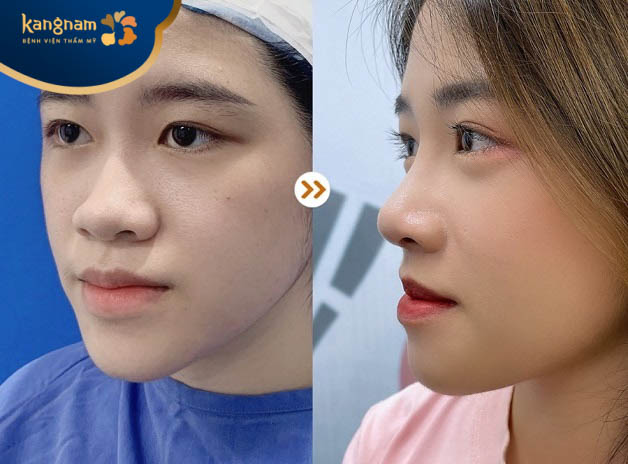 Khách hàng nhanh chóng có được dáng mũi cao, thẳng