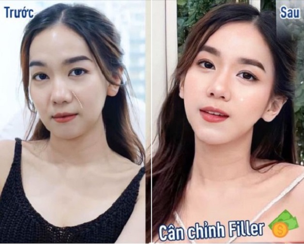 Chị Mai Thùy trước và sau khi tiêm filler rãnh cười