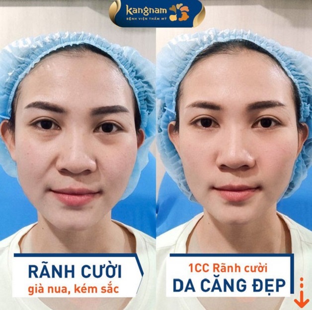 Tiêm filler rãnh cười tại Kangnam Cần Thơ