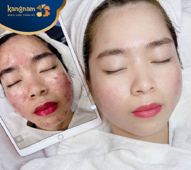 Làn da sạch mụn, mờ thâm sau điều trị 