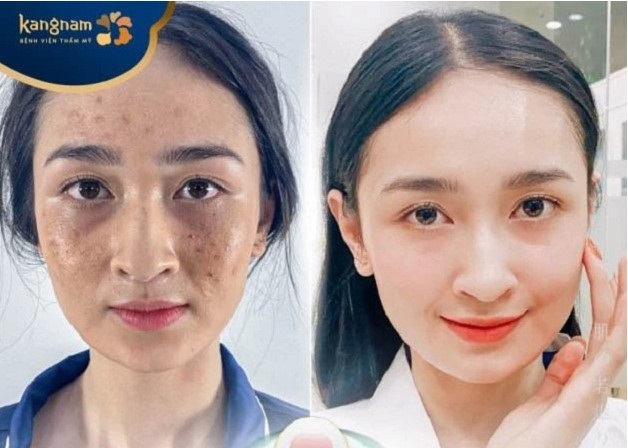 Da sáng đều màu, mụn được điều trị khỏi hoàn toàn