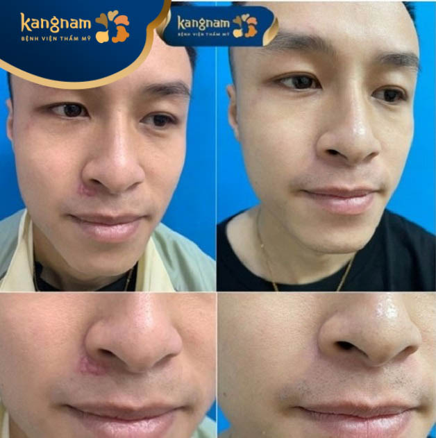 Sẹo lồi "tàng hình" sau trị liệu tại Kangnam Bình Dương