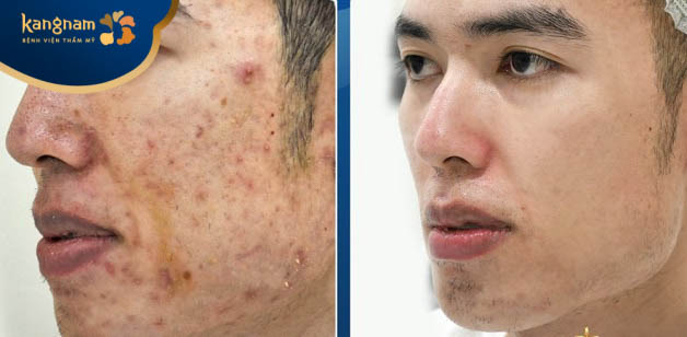 Khách hàng điều trị sẹo thâm mụn tại Kangnam Bình Dương