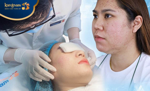 Kangnam Bình Dương là địa chỉ trị sẹo uy tín