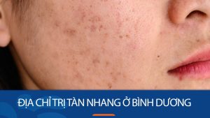 Địa chỉ trị tàn nhang ở Bình Dương – Sạch đốm nâu, không tái phát