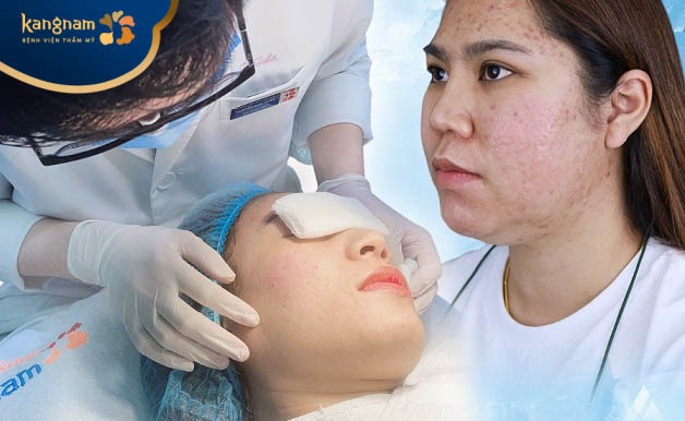 Tiến hành trị mụn bằng phương pháp phù hợp