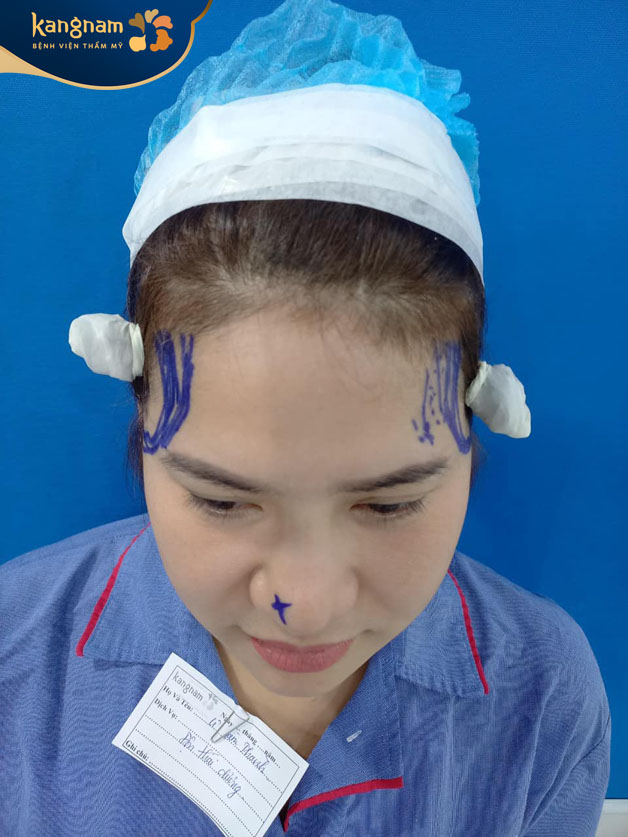 Đo vẽ, thiết kế vùng độn 2 bên thái dương