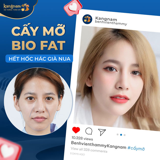 Cấy mỡ mặt tự thân mang lại vẻ đẹp mềm mại, tự nhiên