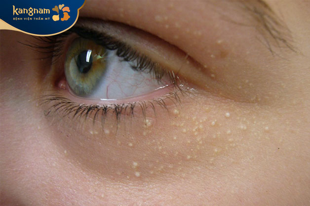 Mụn thịt gây mất thẩm mỹ