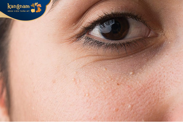 Mụn thịt khiến da sần sùi