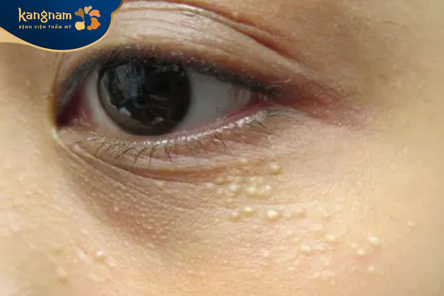 Mụn thịt dày đặc, khiến da không đều màu