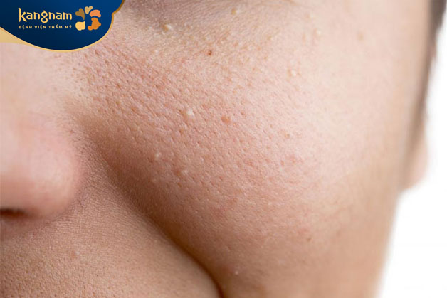 Mụn thịt li ti ở má và gò má