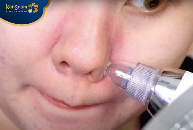 Phương pháp hút mụn có thể làm tuyến bã nhờn hoạt động mạnh mẽ hơn