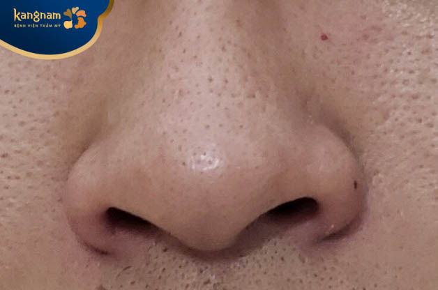 Máy hút mụn khi sử dụng với tần suất thường xuyên làm to lỗ chân lông