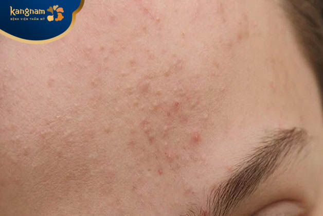 mụn ẩn khi được lấy đúng cách, đúng thời điểm sẽ giúp rút ngắn thời gian điều trị mụn