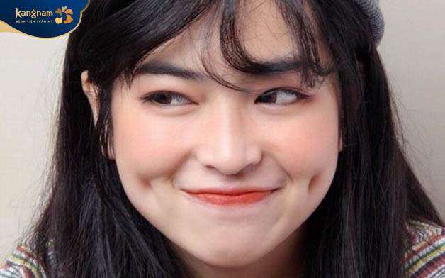 Có 4 dạng má lúm thường gặp