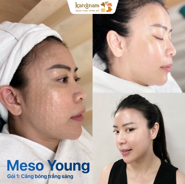 Thông thường, sau tiêm meso 1 lần, bạn đã thấy làn da có sự thay đổi