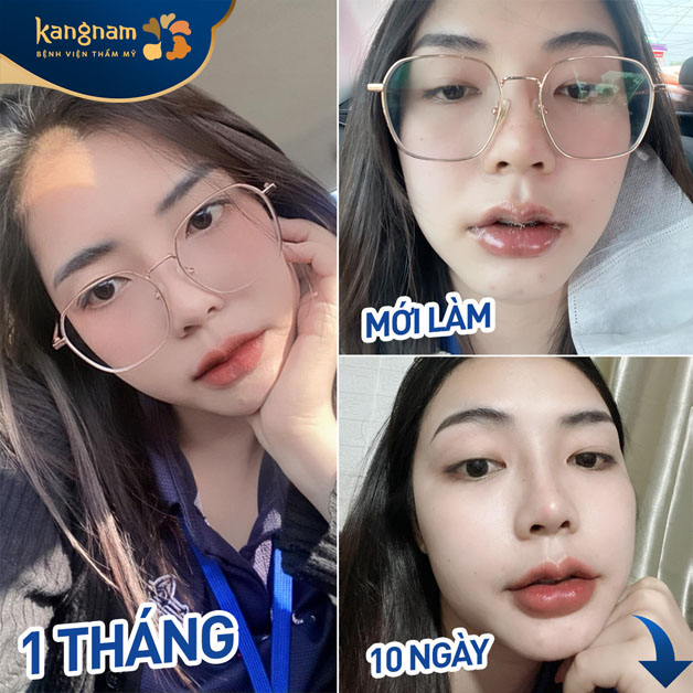 Tạo hình môi trái tim ứng dụng công nghệ hiện đại, nhanh hồi phục