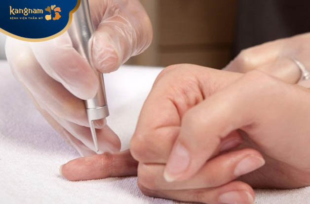 Đốt laser để điều trị mụn hạt cơm