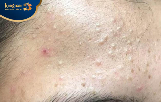 Vị trí mụn trên trán