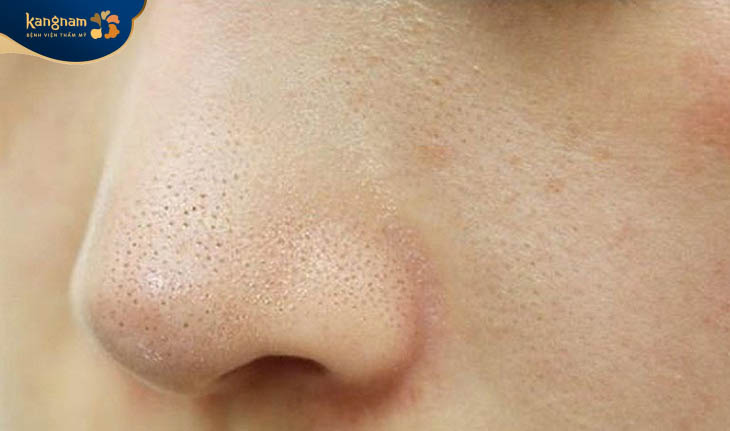 Các nốt mụn li ti mọc theo từng cụm tại mũi