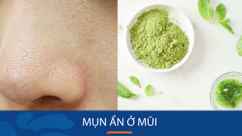 Mũi Sạch Mụn Chỉ Trong 3 Bước – Đánh Bay Mụn Ẩn Nhanh Chóng, An Toàn