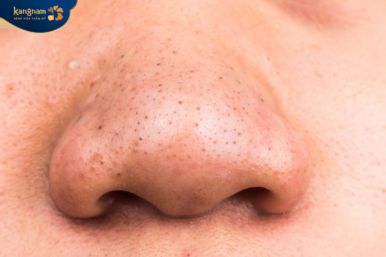 Nốt mụn sần sùi, không sưng, không gây đau