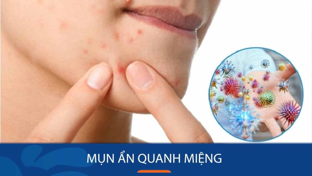 Lộ bí kíp “đánh bay” mụn ẩn quanh miệng hiệu quả 100%, da mịn màng không tì vết.