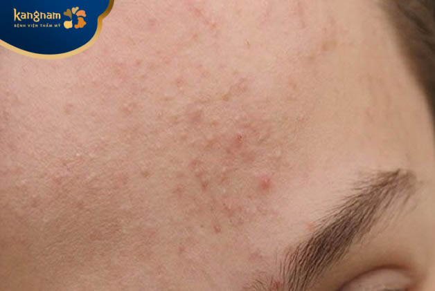 Vệ sinh da không sạch sẽ có thể là nguyên nhân hình thành mụn