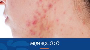 Mụn bọc ở cổ – Tìm hiểu nguyên nhân, giai đoạn phát triển và cách điều trị dứt điểm