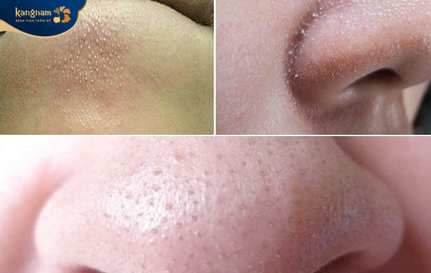 Làn da hình thành mụn cám do tắc nghẽn lỗ chân lông