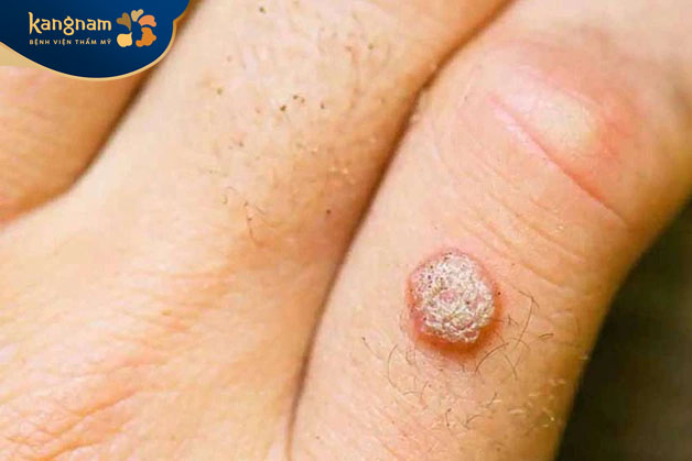 Mụn cóc thường không gây đau đớn, khó chịu