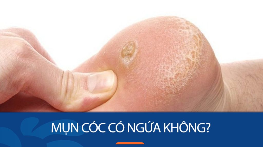 Mụn cóc: Ngứa, Lây lan và Cách Điều trị Hiệu quả