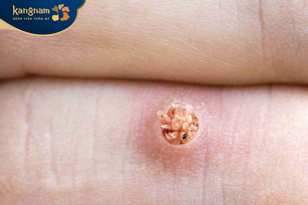 Mụn cóc có thể gây ngứa ngáy khi mọc ở vị trí như vùng đáy chậu