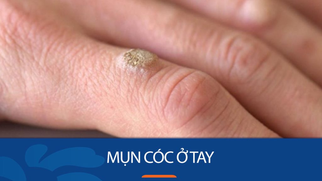 Mụn cóc tay – Nỗi ám ảnh da liễu: Nguyên nhân, cách trị & phòng ngừa hiệu quả