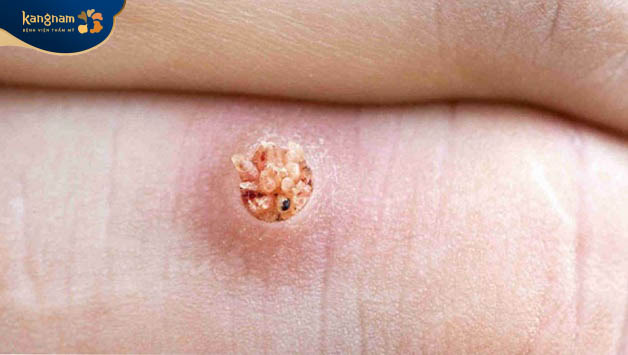 Mụn cóc do virus HPV gây nên