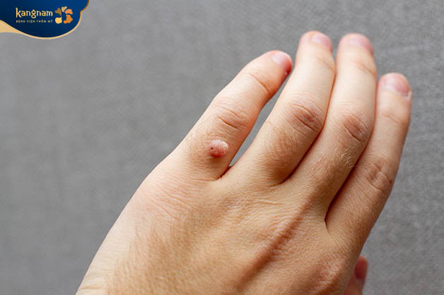 Những người suy giảm miễn dịch, rối loạn chuyển hóa dễ nhiễm virus