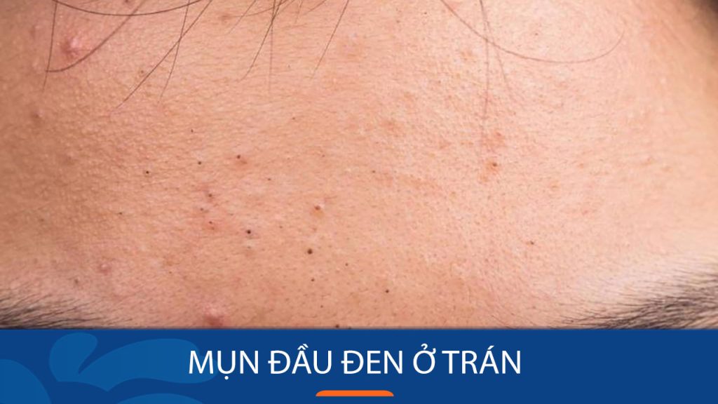 Mụn đầu đen ở trán: “Đánh bay” tận gốc với bí quyết từ chuyên gia