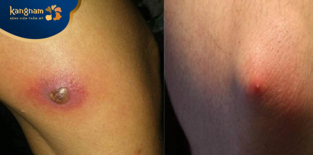 Mụn đinh râu ở đầu gối