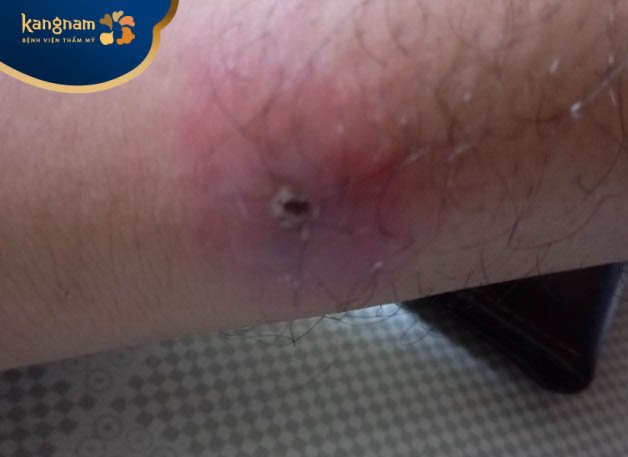 Nguyên nhân hình thành mụn đinh râu 