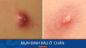 Mụn đinh râu ở chân – Nguy cơ tiềm ẩn và cách phòng ngừa hiệu quả