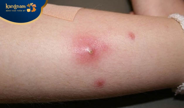 Mụn đinh râu mọc ở bắp chân