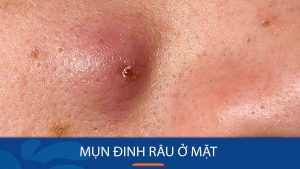 Mụn Đinh Râu ở mặt: Giải mã nguyên nhân, triệu chứng và cách trị dứt điểm