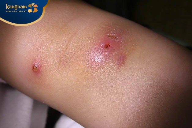 Nhiễm trùng da cũng là nguyên nhân gây hình thành mụn đinh râu