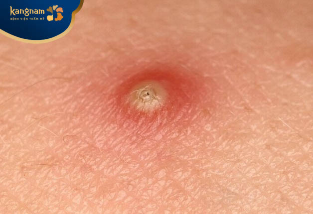 Mụn đinh râu mọc trên tay