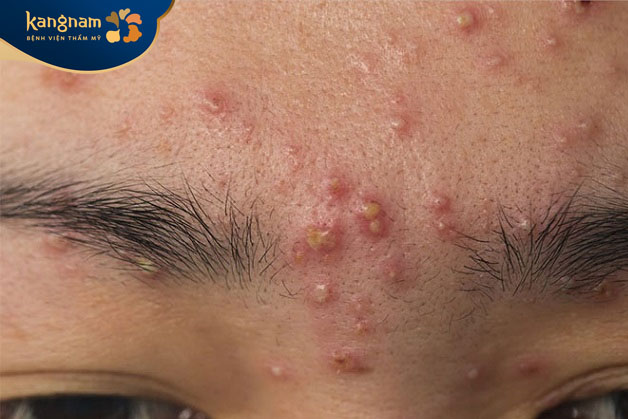 Mụn mủ nếu không nặn sẽ không thể loại bỏ hoàn toàn