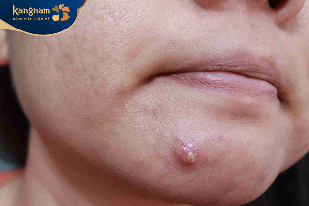 Mụn mủ nên được nặn khi đã có nhân mủ bên trong